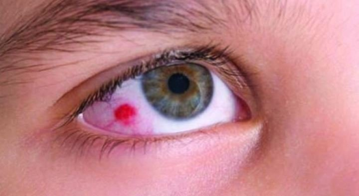 Eyeball Cancer 