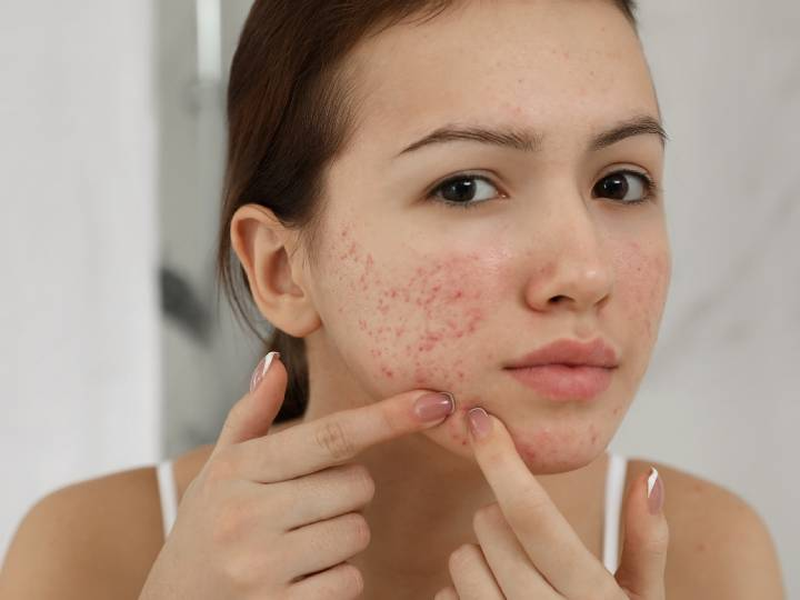 Ajwain Benefits for Skin